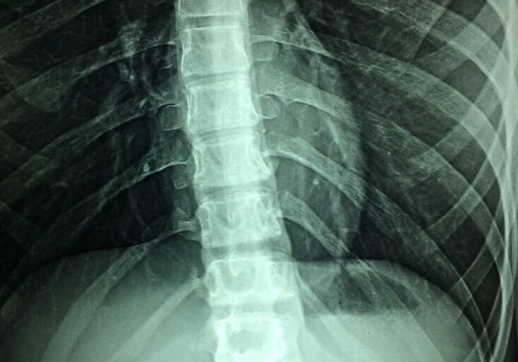 What-Causes-Spinal-Cord-Injuries-in-Georgia